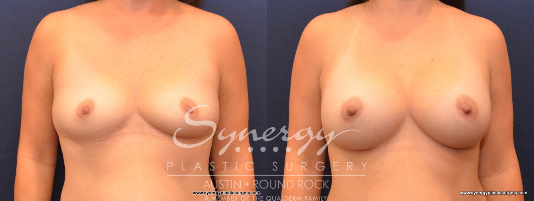 Before & After Breast Augmentation Case 559 View #1 View in Austin, TX