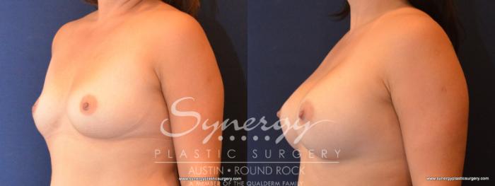 Before & After Breast Augmentation Case 559 View #2 View in Austin, TX
