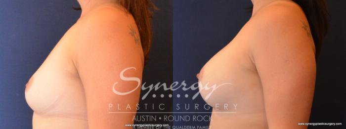 Before & After Breast Augmentation Case 559 View #3 View in Austin, TX