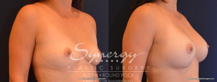 Before & After Breast Augmentation Case 559 View #4 View in Austin, TX