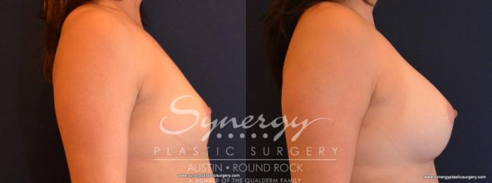 Before & After Breast Augmentation Case 559 View #5 View in Austin, TX