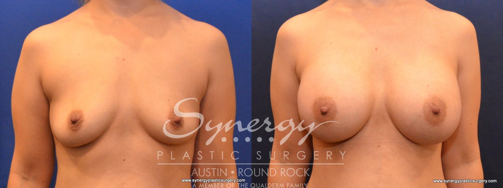 Before & After Breast Augmentation Case 560 View #1 View in Austin, TX