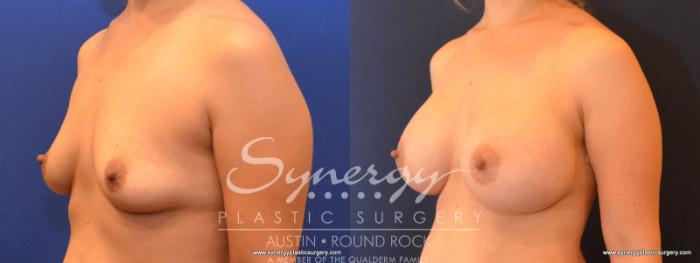 Before & After Breast Augmentation Case 560 View #2 View in Austin, TX