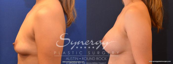 Before & After Breast Augmentation Case 560 View #3 View in Austin, TX