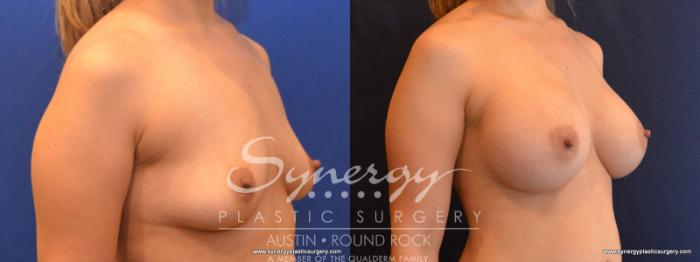 Before & After Breast Augmentation Case 560 View #4 View in Austin, TX