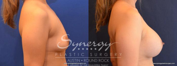 Before & After Breast Augmentation Case 560 View #5 View in Austin, TX