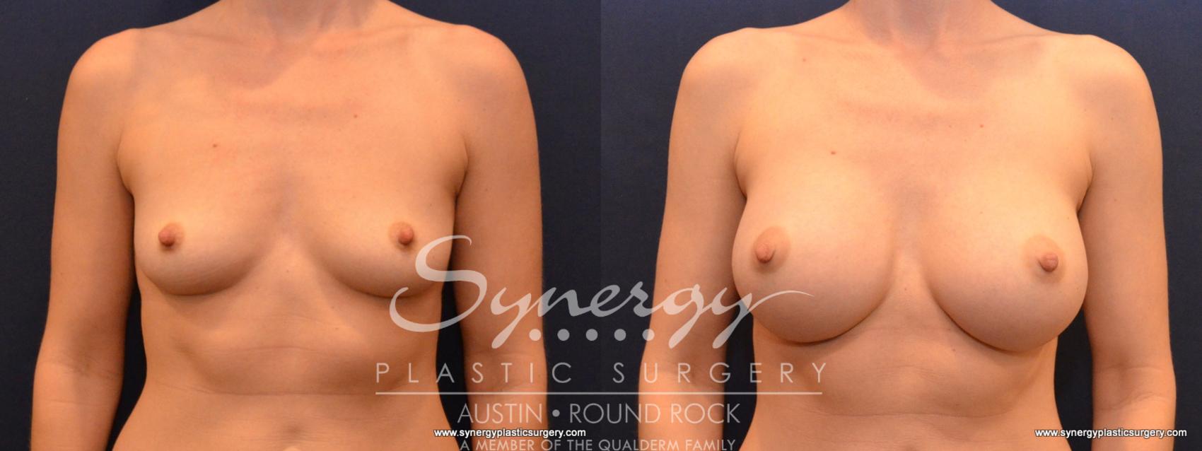 Before & After Breast Augmentation Case 562 View #1 View in Austin, TX