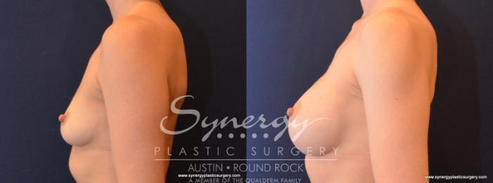 Before & After Breast Augmentation Case 562 View #3 View in Austin, TX