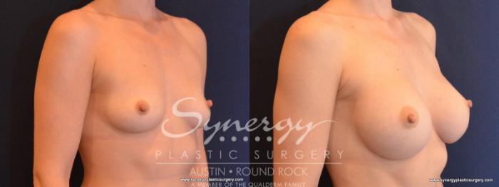 Before & After Breast Augmentation Case 562 View #4 View in Austin, TX