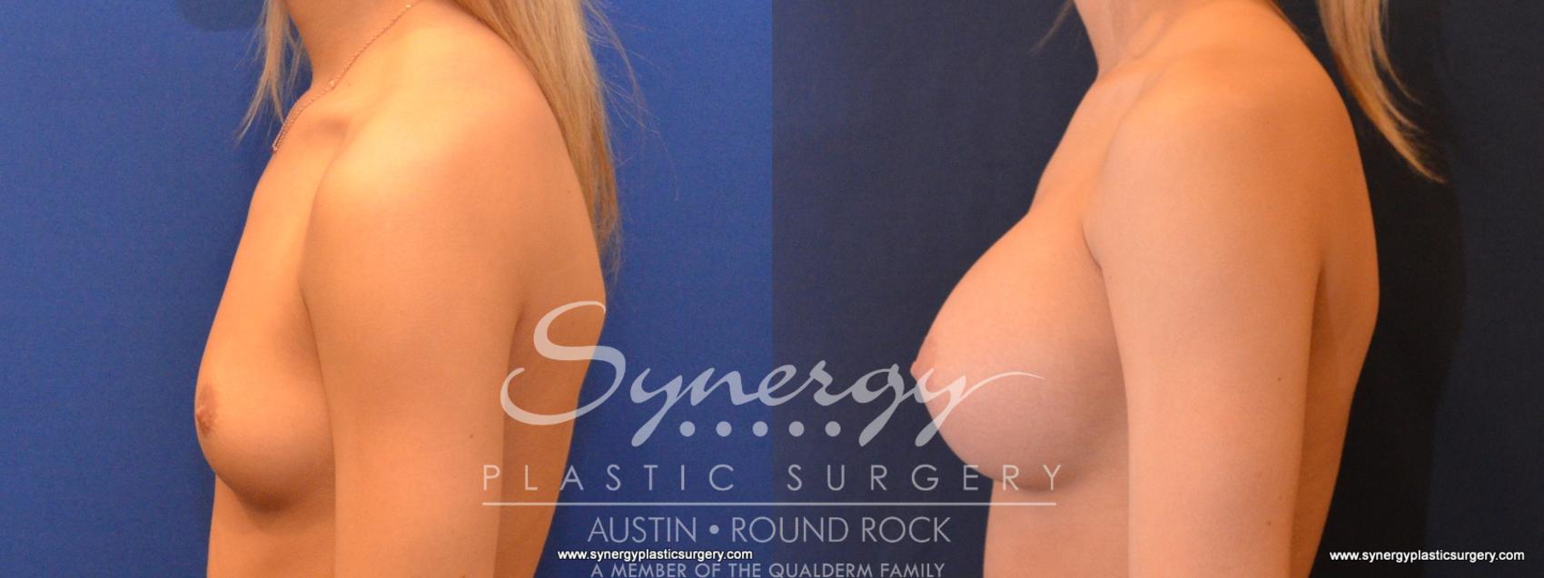 Before & After Breast Augmentation Case 563 View #1 View in Austin, TX