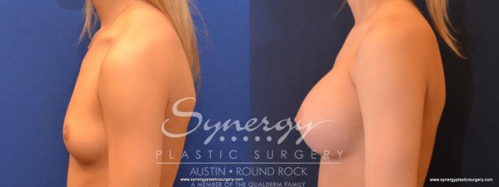 Before & After Breast Augmentation Case 563 View #1 View in Austin, TX