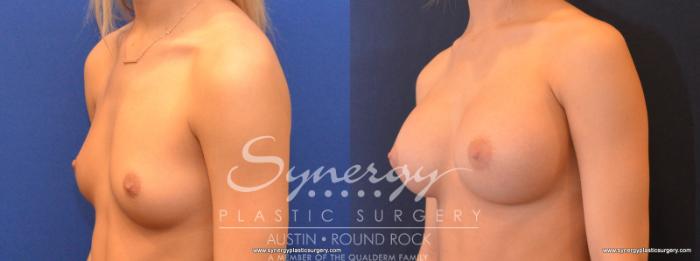 Before & After Breast Augmentation Case 563 View #2 View in Austin, TX