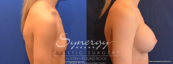 Before & After Breast Augmentation Case 563 View #3 View in Austin, TX