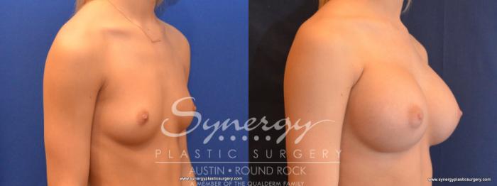 Before & After Breast Augmentation Case 563 View #4 View in Austin, TX