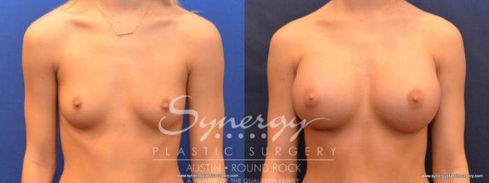 Before & After Breast Augmentation Case 563 View #5 View in Austin, TX
