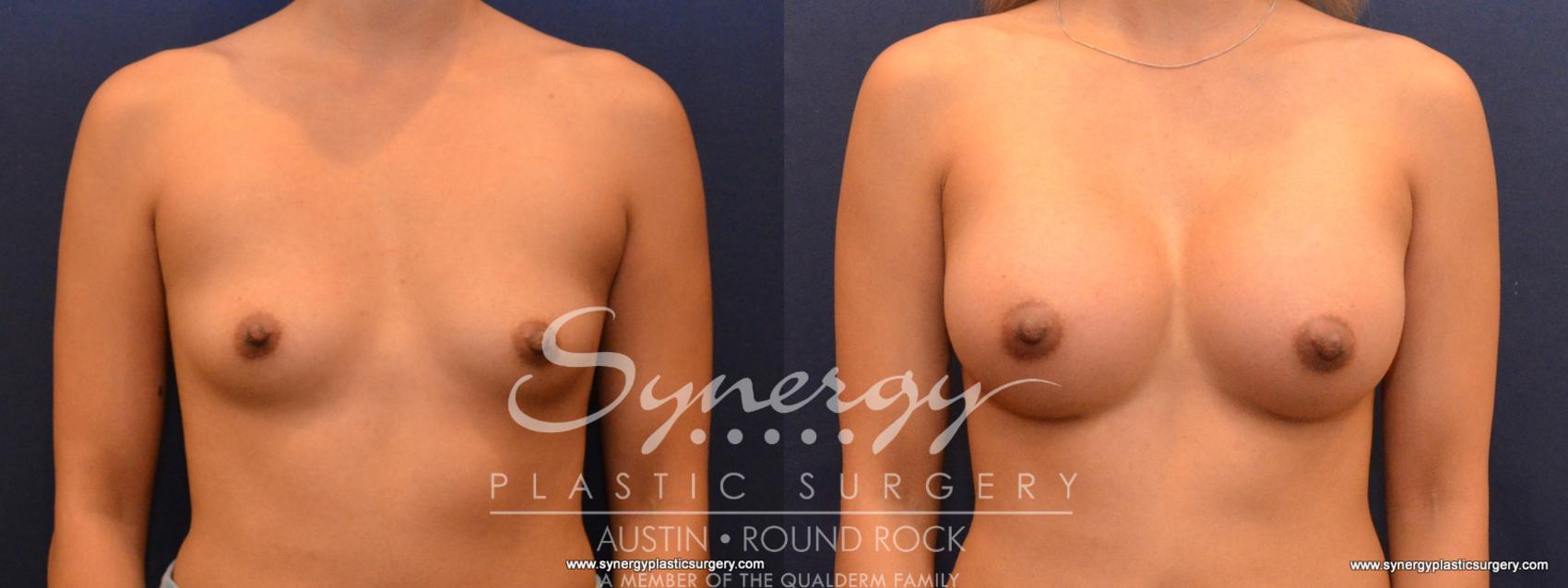 Before & After Breast Augmentation Case 564 View #1 View in Austin, TX
