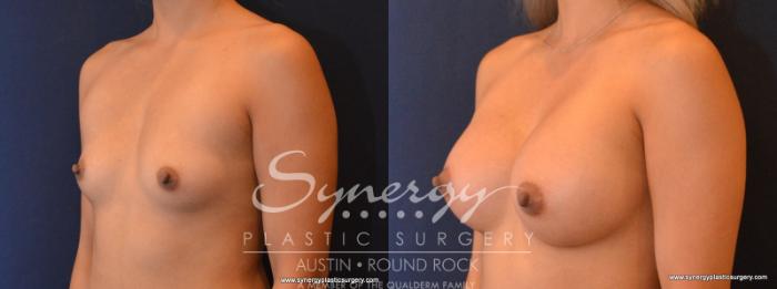 Before & After Breast Augmentation Case 564 View #2 View in Austin, TX