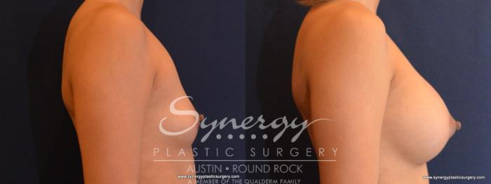 Before & After Breast Augmentation Case 564 View #3 View in Austin, TX