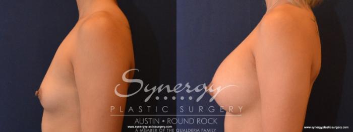 Before & After Breast Augmentation Case 564 View #4 View in Austin, TX