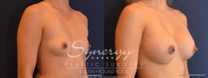 Before & After Breast Augmentation Case 564 View #5 View in Austin, TX