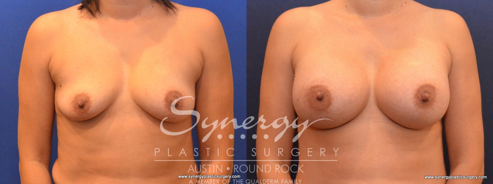 Before & After Breast Augmentation Case 567 View #1 View in Austin, TX
