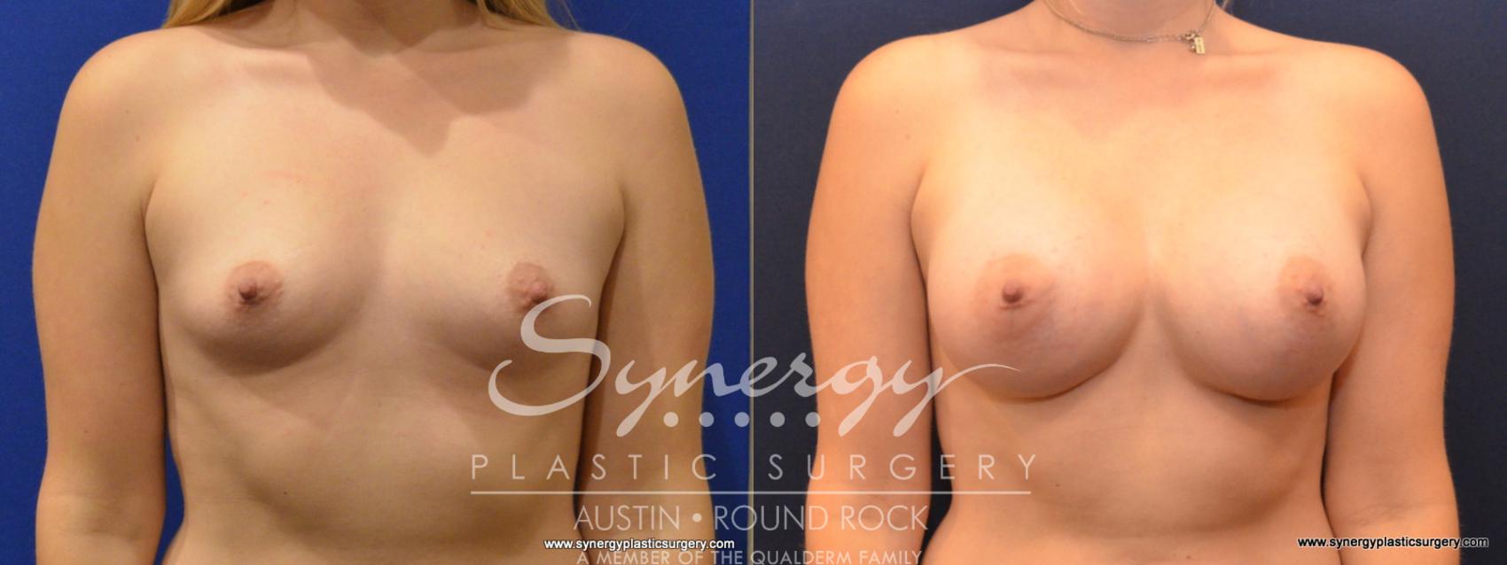Before & After Breast Augmentation Case 569 View #1 View in Austin, TX