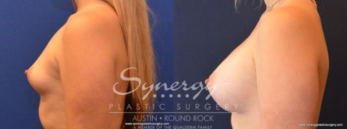 Before & After Breast Augmentation Case 569 View #2 View in Austin, TX