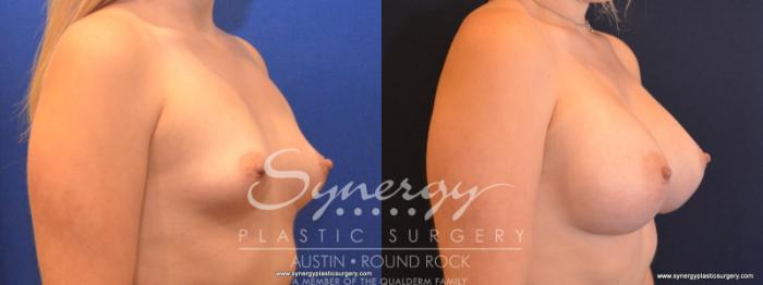 Before & After Breast Augmentation Case 569 View #3 View in Austin, TX