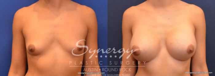 Before & After Breast Augmentation Case 572 View #1 View in Austin, TX