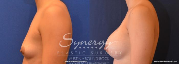 Before & After Breast Augmentation Case 572 View #3 View in Austin, TX