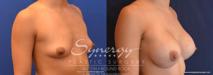 Before & After Breast Augmentation Case 572 View #4 View in Austin, TX