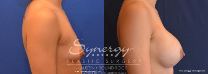 Before & After Breast Augmentation Case 572 View #5 View in Austin, TX