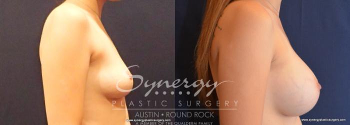 Before & After Breast Augmentation Case 580 View #3 View in Austin, TX