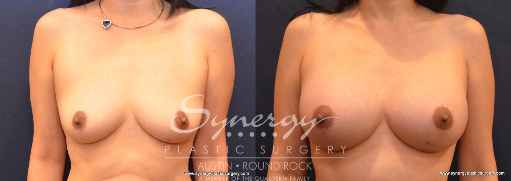 Before & After Breast Augmentation Case 586 View #1 View in Austin, TX