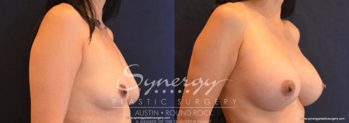 Before & After Breast Augmentation Case 586 View #4 View in Austin, TX