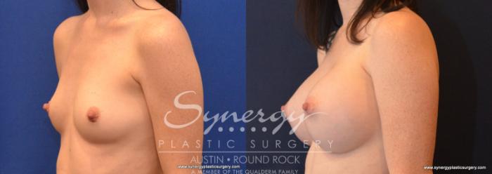 Before & After Breast Augmentation Case 587 View #2 View in Austin, TX