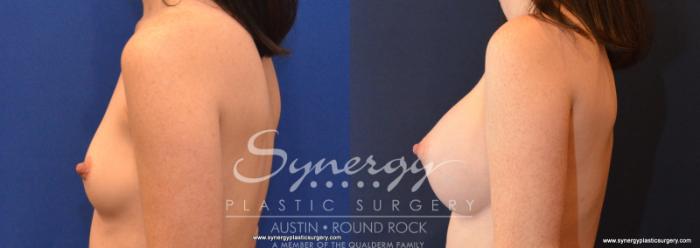 Before & After Breast Augmentation Case 587 View #3 View in Austin, TX