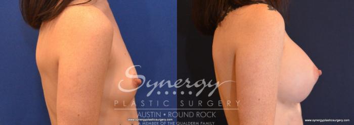 Before & After Breast Augmentation Case 587 View #4 View in Austin, TX