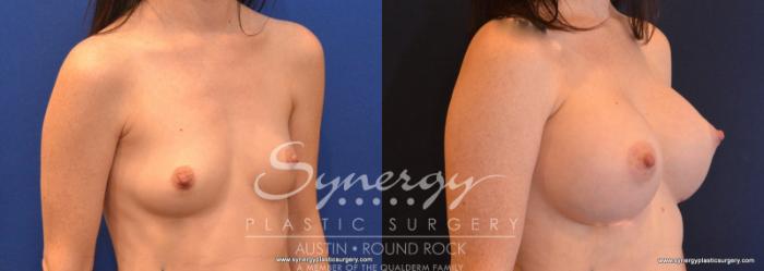 Before & After Breast Augmentation Case 587 View #5 View in Austin, TX