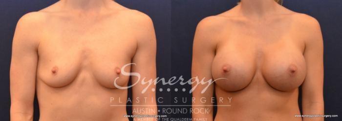 Before & After Breast Augmentation Case 589 View #1 View in Austin, TX