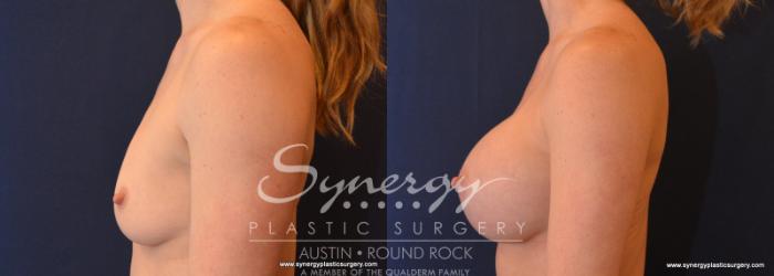 Before & After Breast Augmentation Case 589 View #3 View in Austin, TX