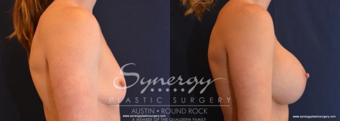 Before & After Breast Augmentation Case 589 View #4 View in Austin, TX