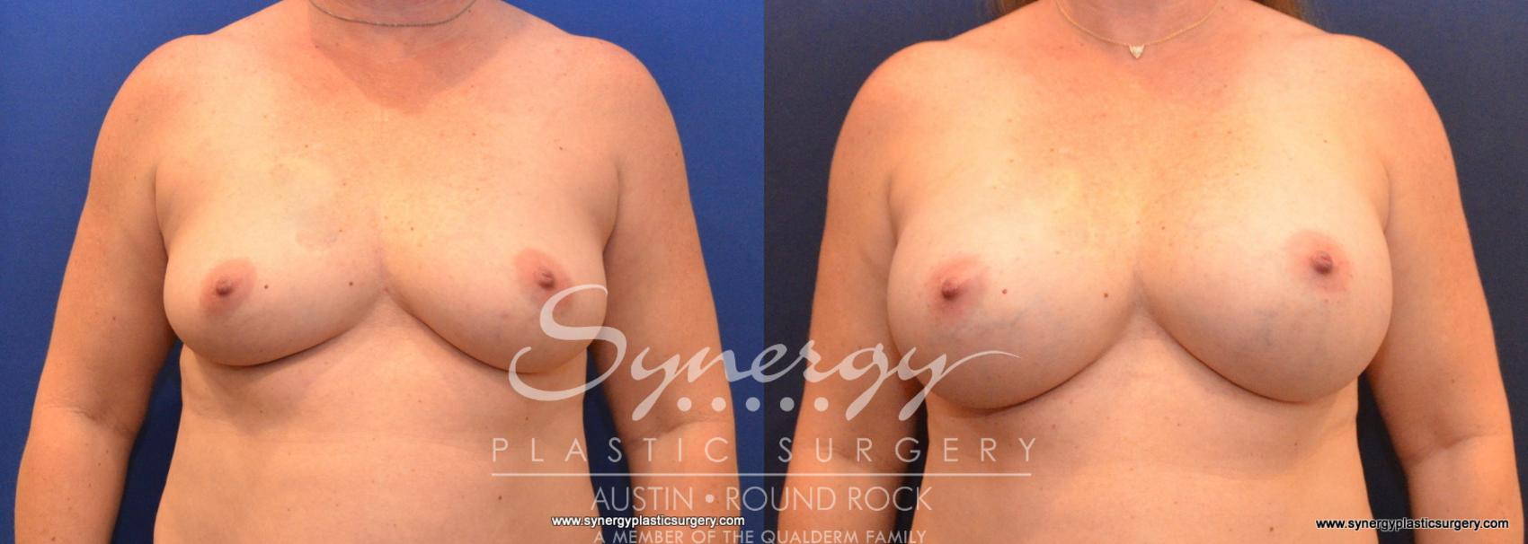 Before & After Breast Augmentation Case 590 View #1 View in Austin, TX