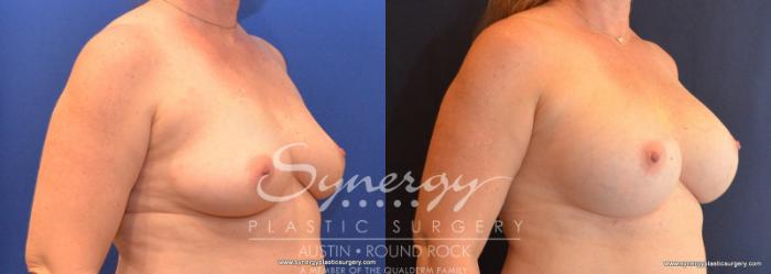Before & After Breast Augmentation Case 590 View #2 View in Austin, TX