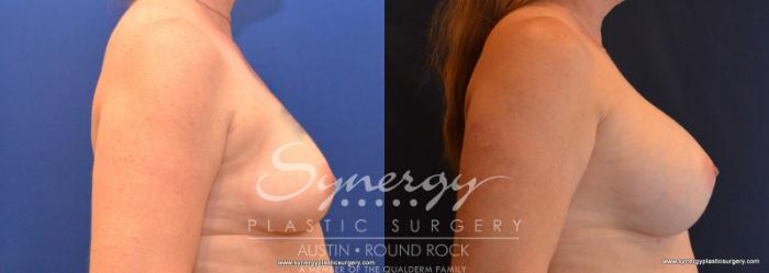 Before & After Breast Augmentation Case 590 View #3 View in Austin, TX
