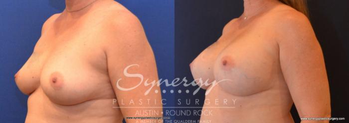 Before & After Breast Augmentation Case 590 View #4 View in Austin, TX
