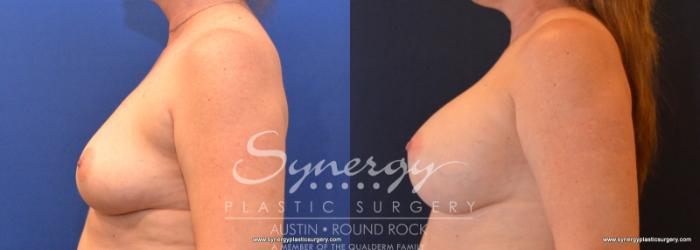 Before & After Breast Augmentation Case 590 View #5 View in Austin, TX