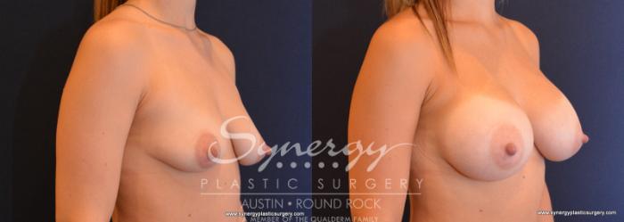 Before & After Breast Augmentation Case 595 View #2 View in Austin, TX