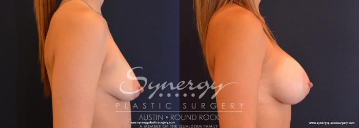 Before & After Breast Augmentation Case 595 View #3 View in Austin, TX