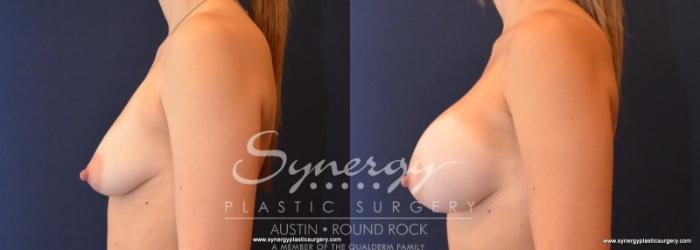 Before & After Breast Augmentation Case 595 View #5 View in Austin, TX